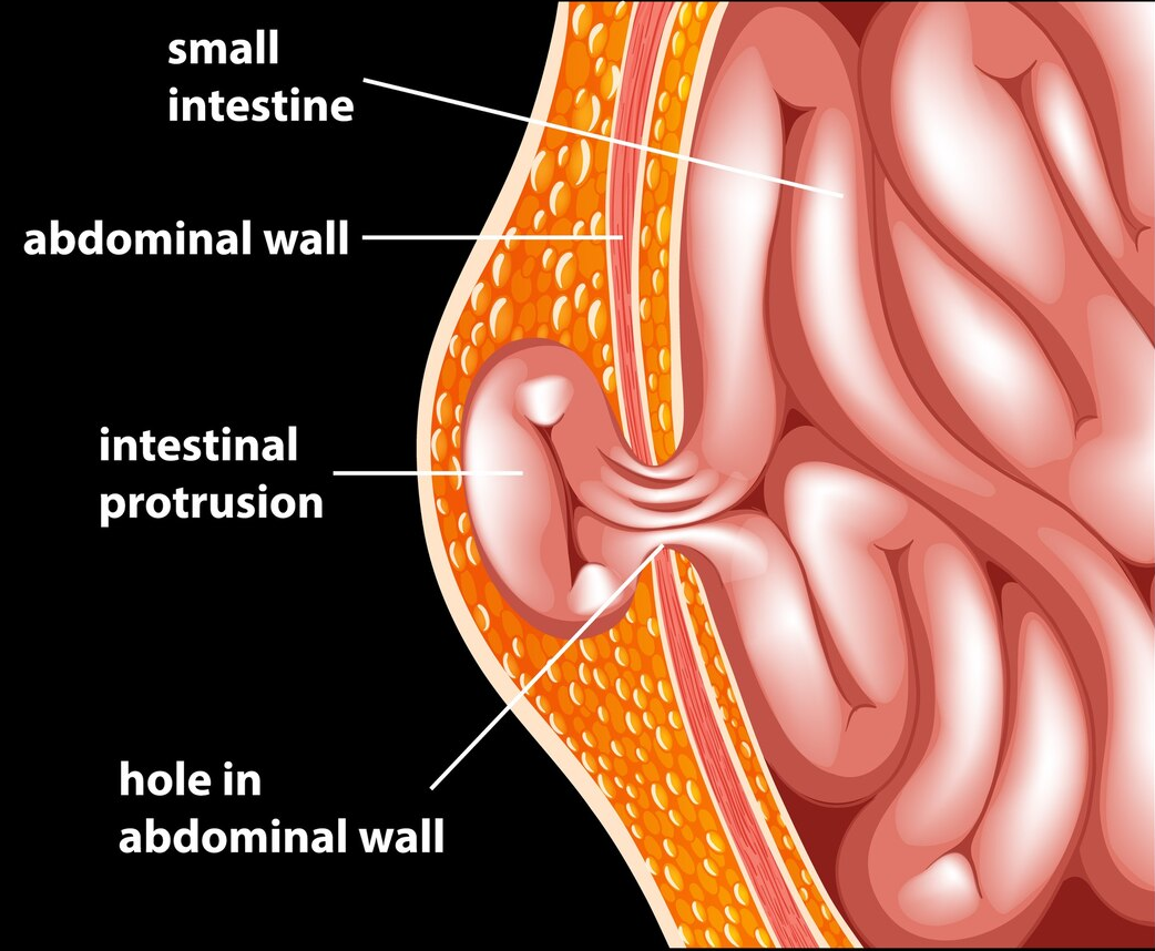 what is an incisional hernia