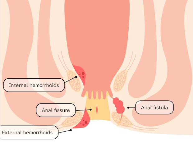 inguinal hernia surgery in dubai