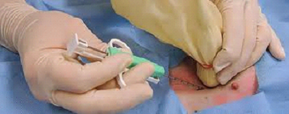 Breast Biopsy in Dubai