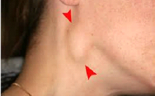 Treatment of enlarged lymph nodes in Dubai