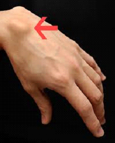 Ganglion Cyst treatment in Jumeirah Dubai