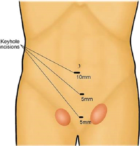 laparoscopic hernia surgery in Dubai