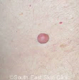 Neurofibroma / Peripheral Nerve Tumors treatment