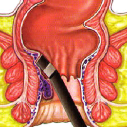 is infrared coagulation painful?