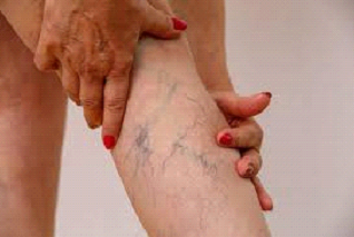 Spider Veins on Legs