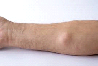 Best Lipoma Treatment In Dubai