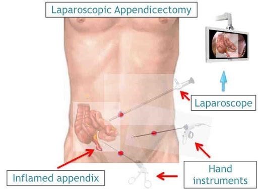 Best Appendicitis Treatment in Dubai