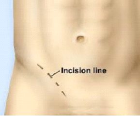 hernia repair Surgery