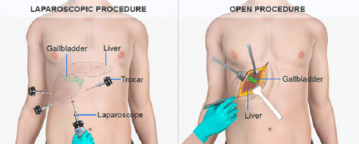 Best Laparoscopic Cholecystectomy Surgery in Dubai By Dr Murtaza Pithawala