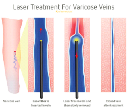 laser treatment for varicose veins​