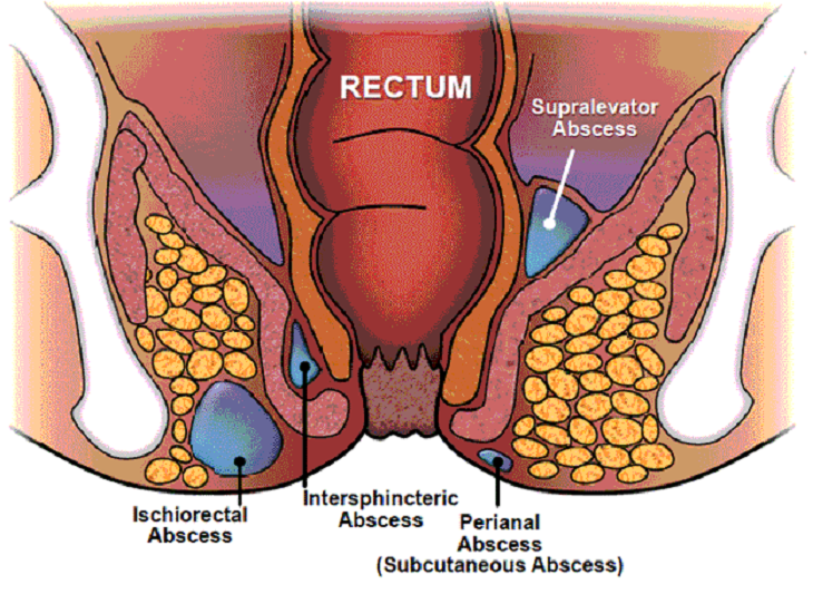 Anal Abscess Surgery Treatment in Dubai