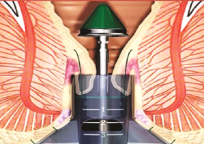 Is stapled hemorrhoidectomy effective?