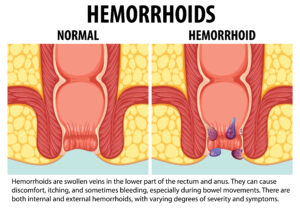 How Hemorrhoid Symptoms appear in a common man ?
