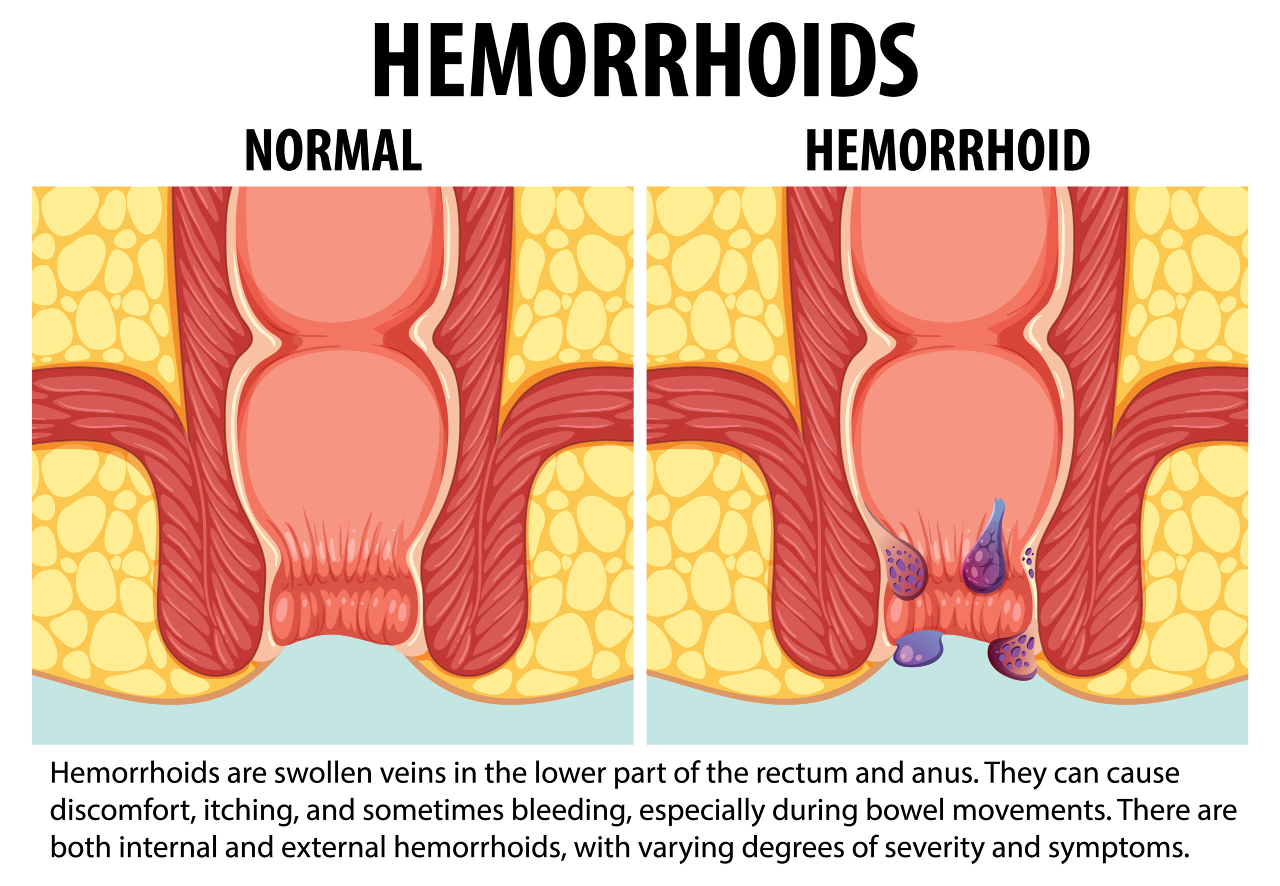How Hemorrhoid Symptoms appear in a common man ?