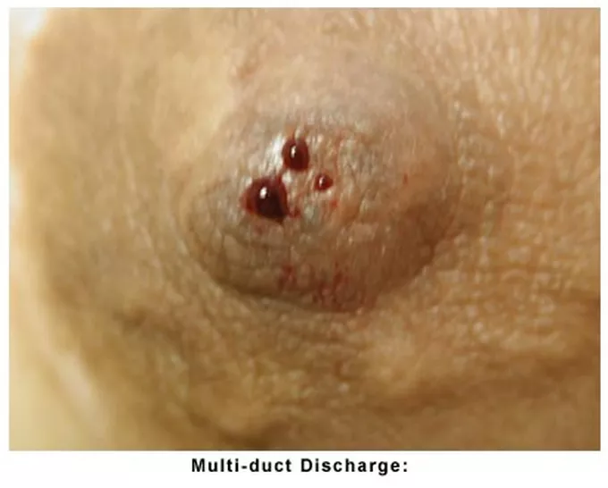 Multi Duct Discharge from Nipple