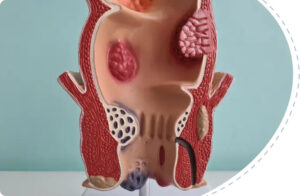 Anal Fissure vs Hemorrhoids Symptoms