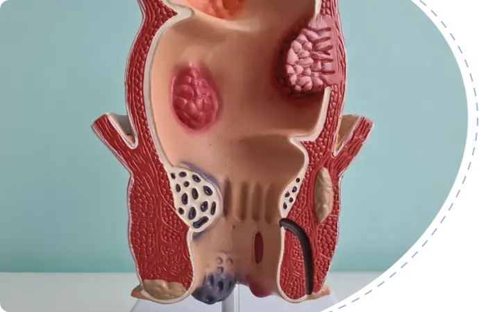 Anal Fissure vs Hemorrhoids Symptoms